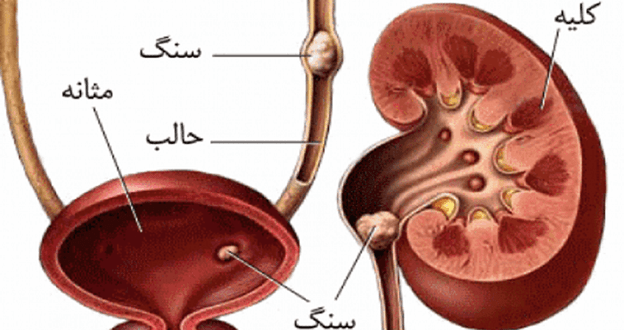 سنگ کلیه و تاثیر آن بر ناتوانی جنسی