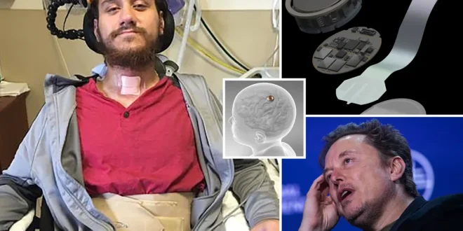 «راه رفتن بیمار فلج با چیپ مغزی ایلان ماسک»